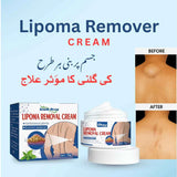 abs South Moon Lipoma Removal Cream